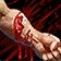 Arterial Bleed